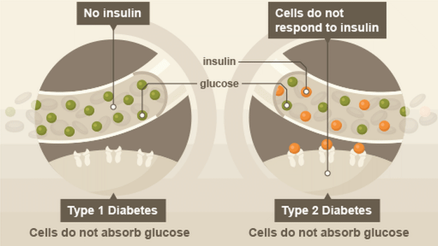 tipi diabetesa